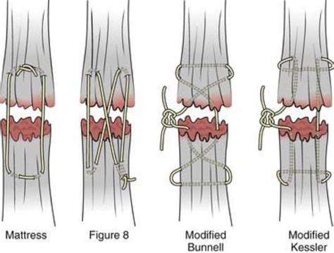 SurgicalTechniquesforFingerTendonRepair
